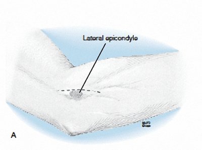 Lateral epicondile