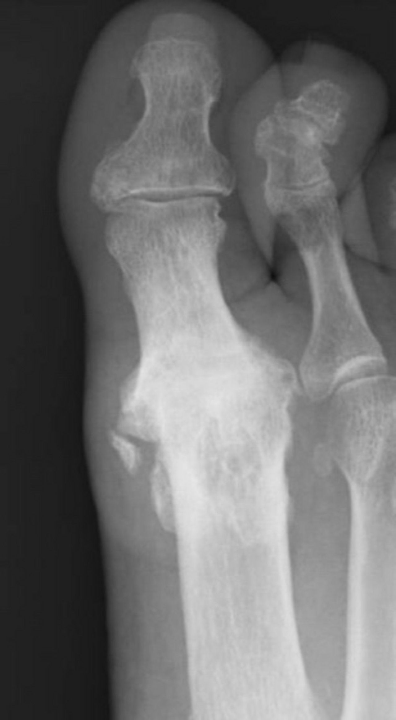 Arthrose Großzehengrundgelenk Arthrose Großzehengrundgelenk
