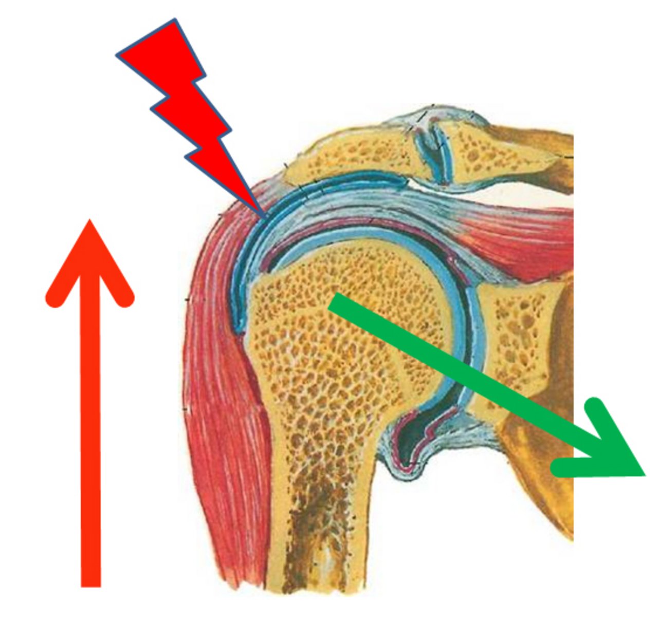 Impingement Impingement