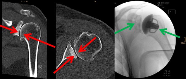 Schulter-Arthrose