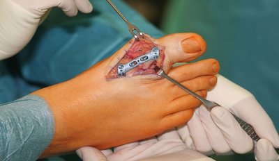 Operation Hallux rigidus, offen