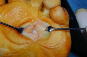 Morton Neurom OP