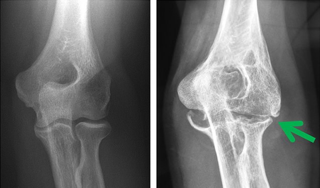 Arthrose Röntgen Arthrose Röntgen