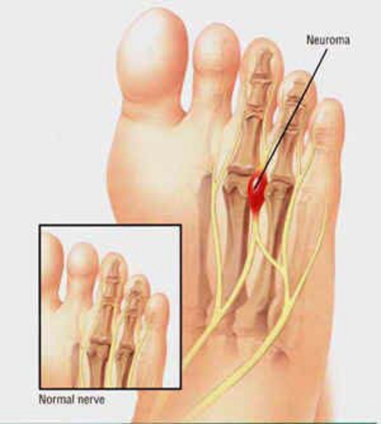 Neuroma Neuroma