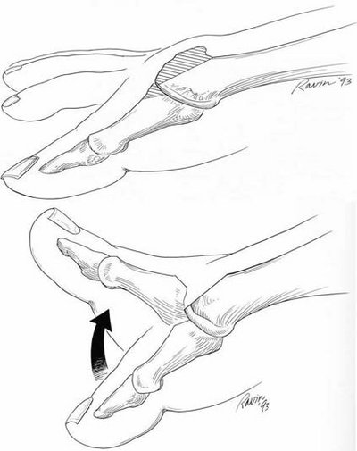 Operation Hallux rigidus
