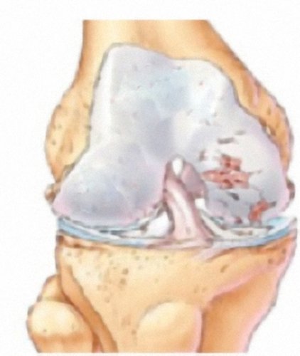 Arthrose Arthrose