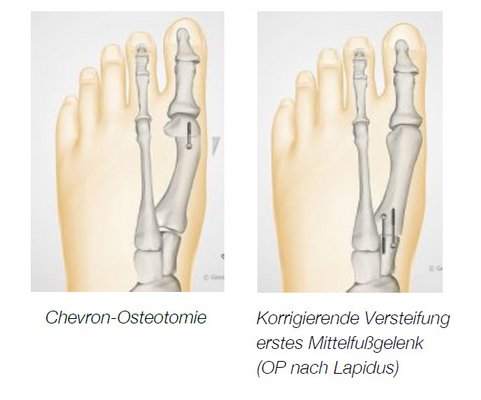 Chevron Osteotomie