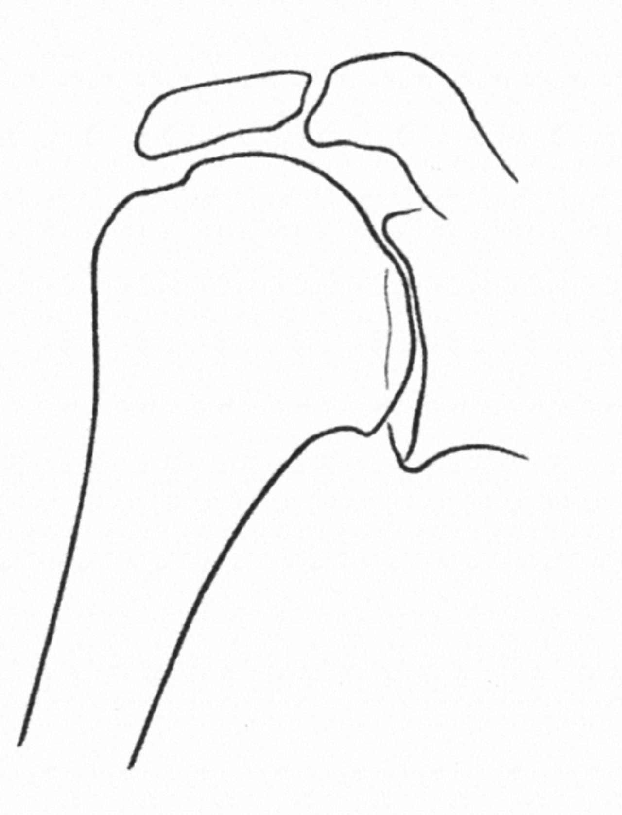 Schulterendoprothese Schulterendoprothese