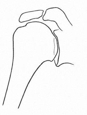 Schulterendoprothese