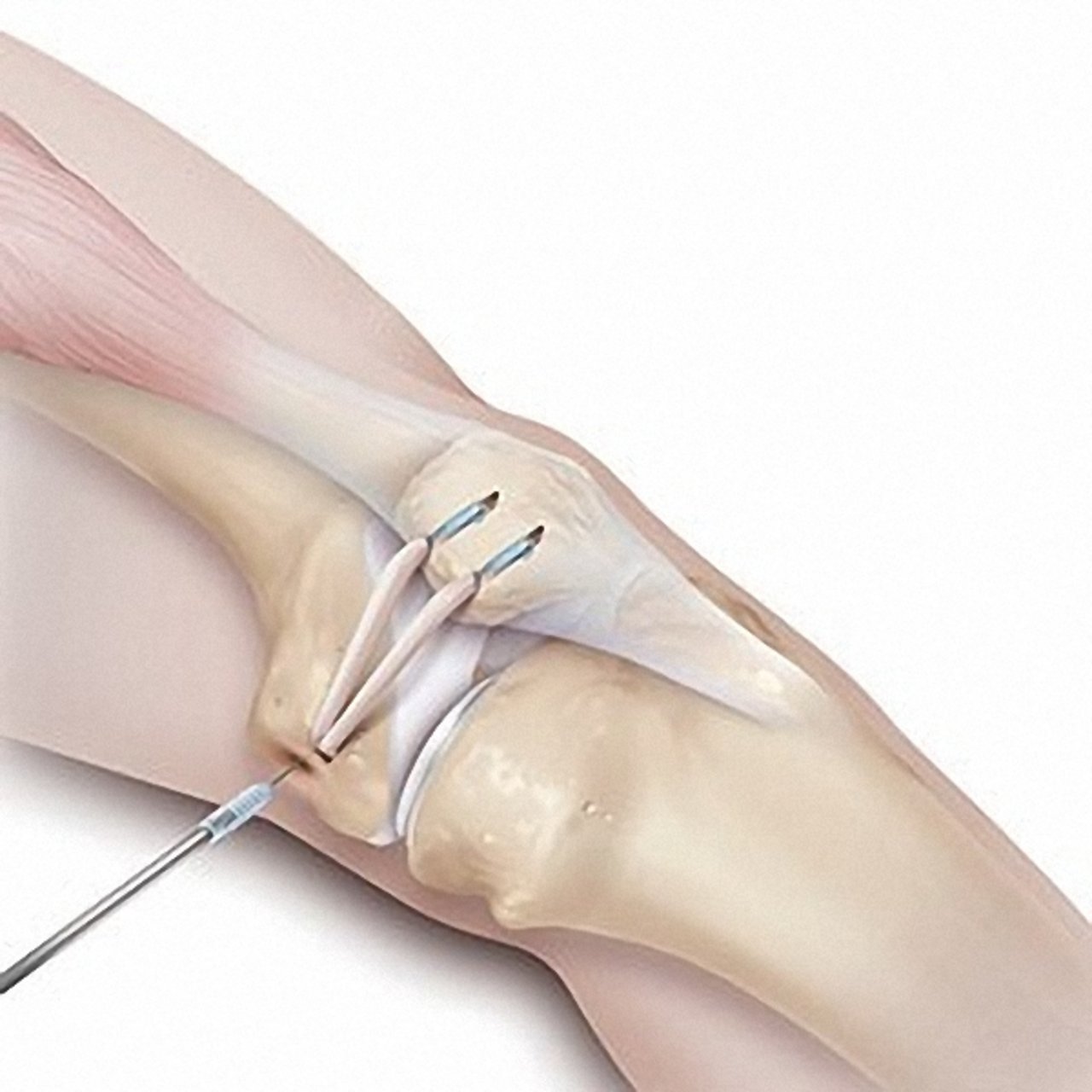 Patellastabilisierung Patellastabilisierung