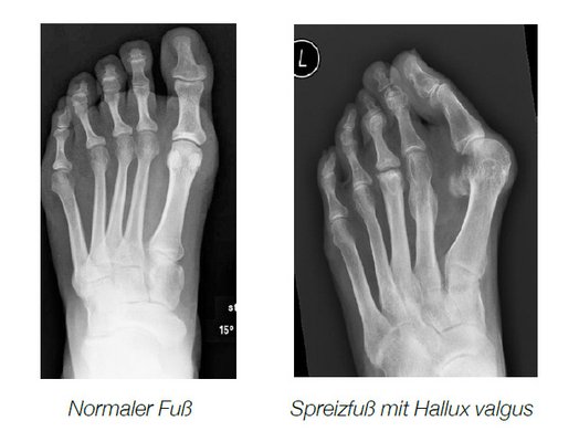 Spreizfuß mit Hallux valgus