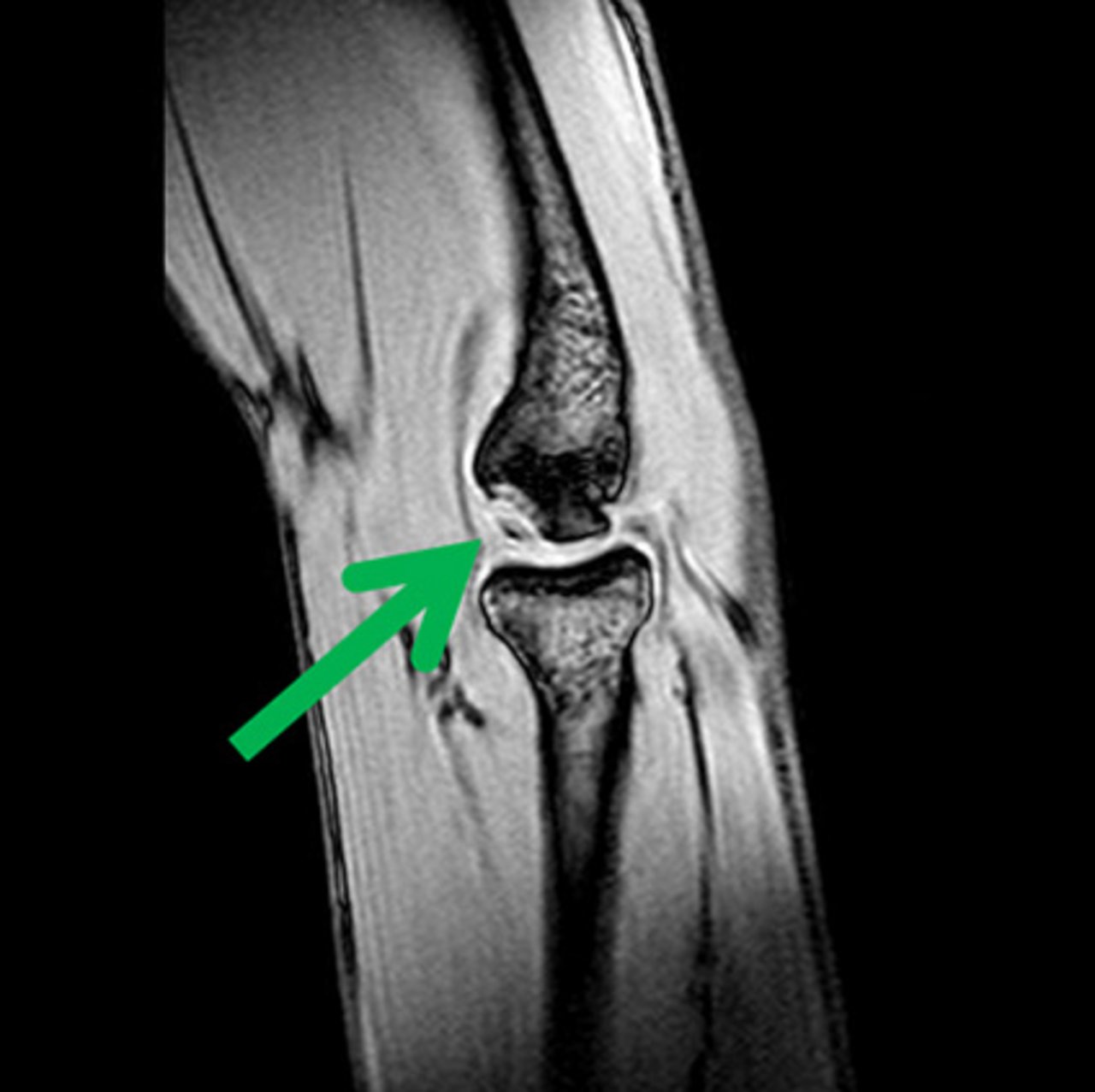 Osteochondrosis dissecans am Ellenbogengelenk bei einem 12-jährigen Turner. Osteochondrosis dissecans am Ellenbogengelenk bei einem 12-jährigen Turner.