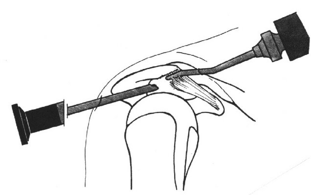 Arthroskopie Arthroskopie