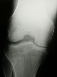Röntgenbild Arthrose