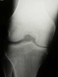 Röntgenbild Arthrose 