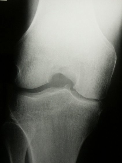 Röntgenbild Arthrose Röntgenbild Arthrose