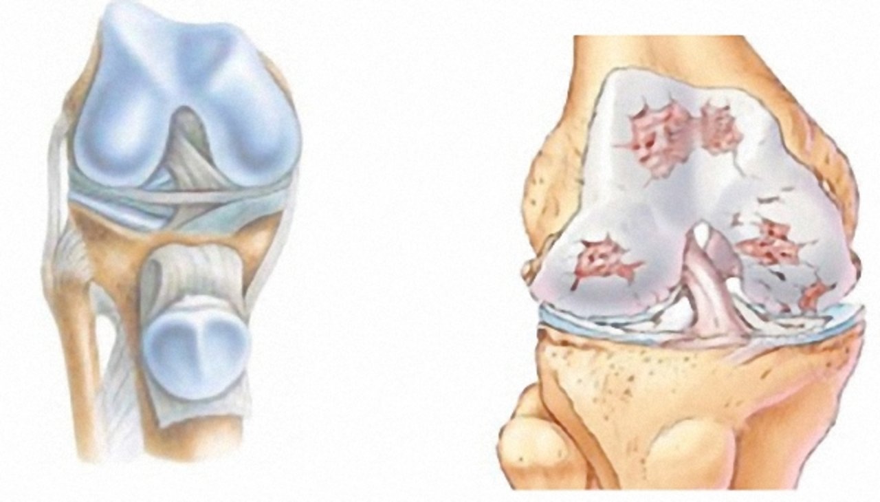 Arthrose Arthrose