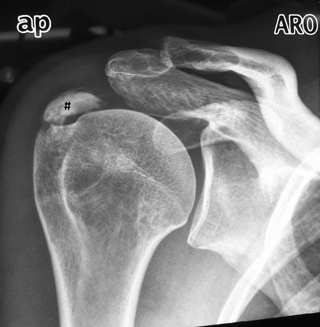 Tendinosis Calcarea Tendinosis Calcarea